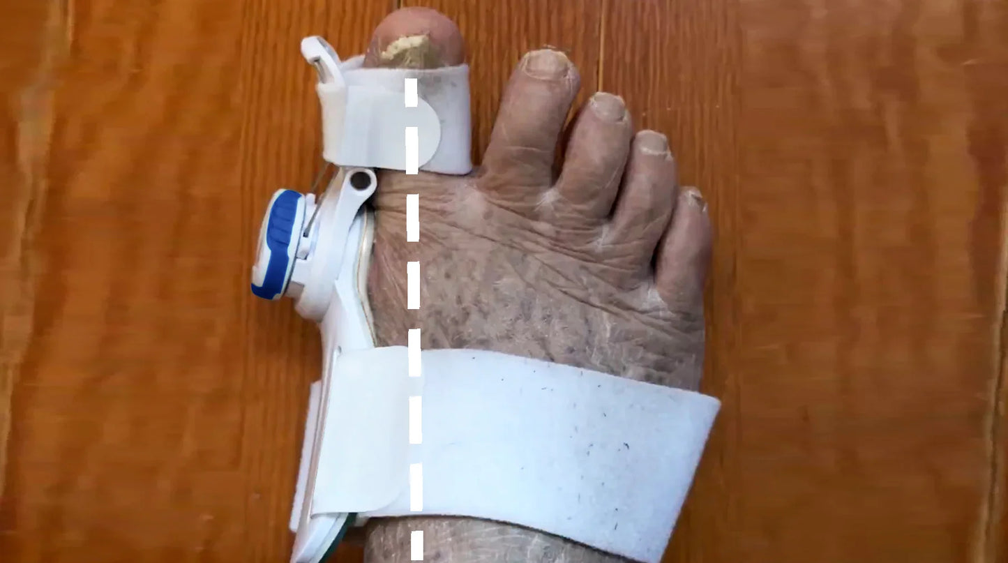 Der Zehen-Trainer: Ihr Weg zur Linderung von Hallux Valgus ohne Operation